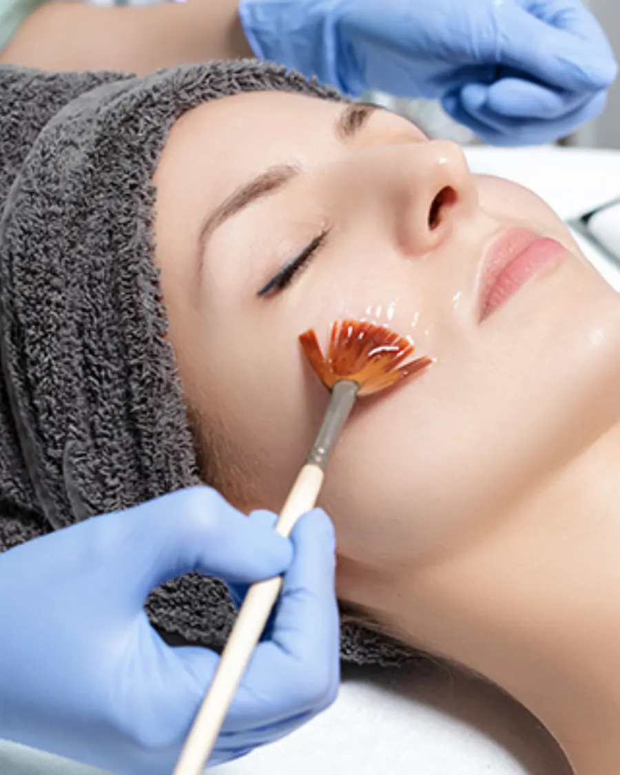 Chemical peels at Cinch Clinics